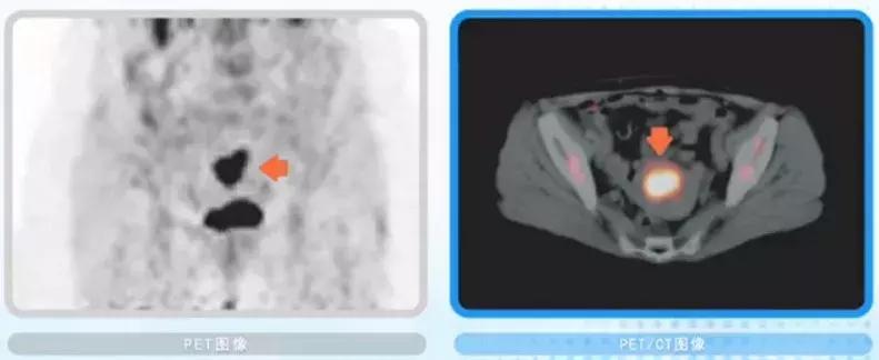 外国早期筛查癌症,petct用于诊断癌症