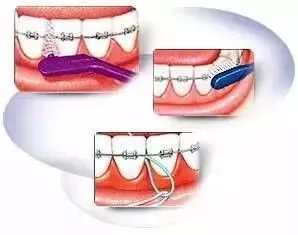 牙齿矫正过程牙套脱落问题,牙齿矫正各种问题以及解决方法