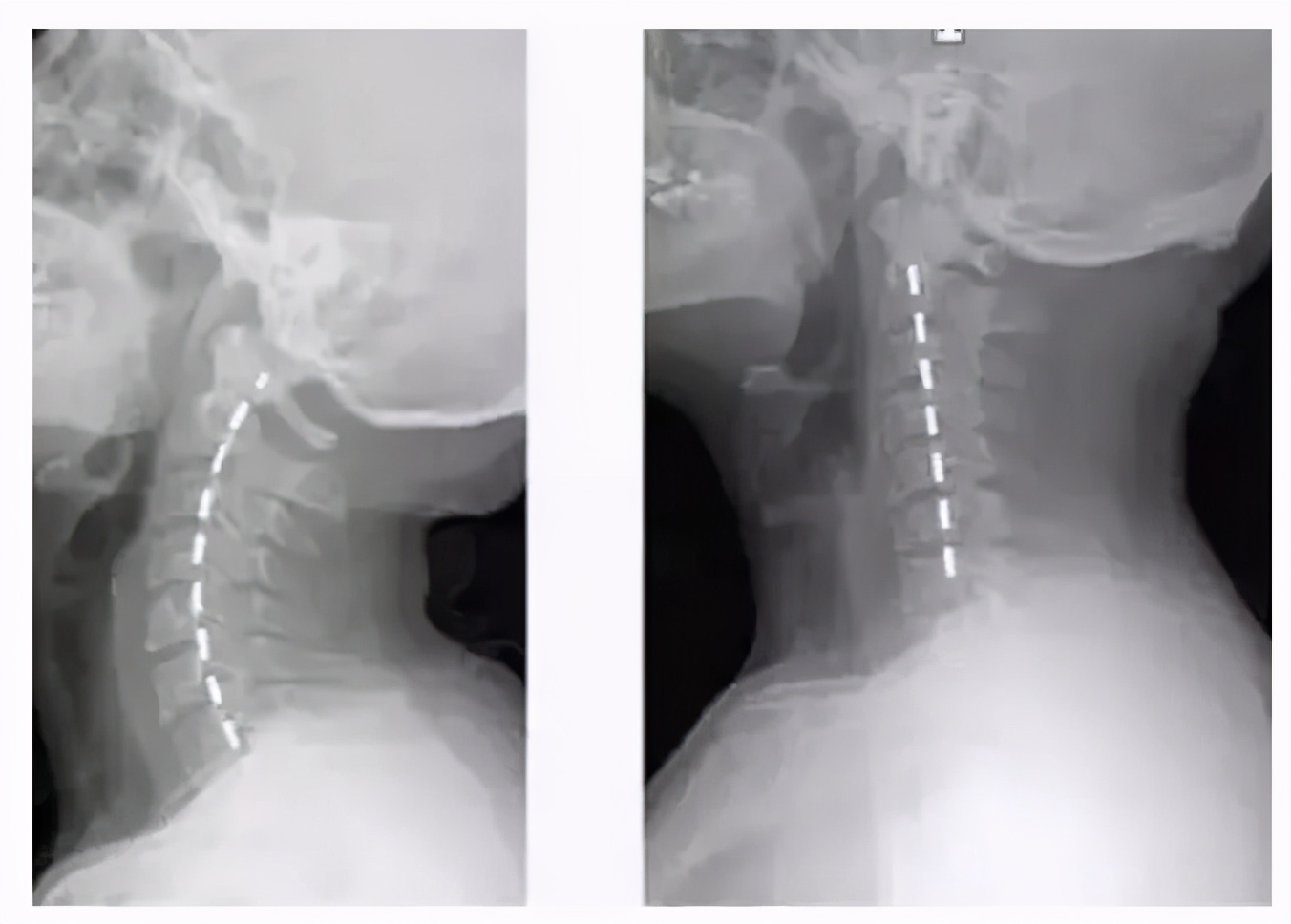 颈椎曲度变直引起脑供血不足,颈椎生理曲度变直症状和治疗方法