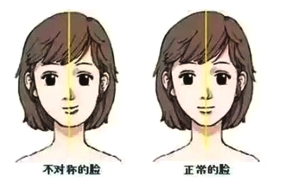 两侧脸不对称是病吗,脸部百分之一的不对称正常吗