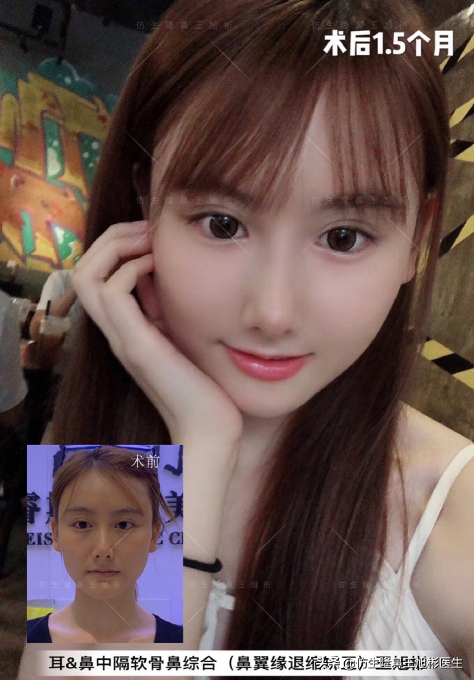 王旭彬：朝天鼻、露鼻孔，模特菲菲短鼻矫正手术后1.5个月