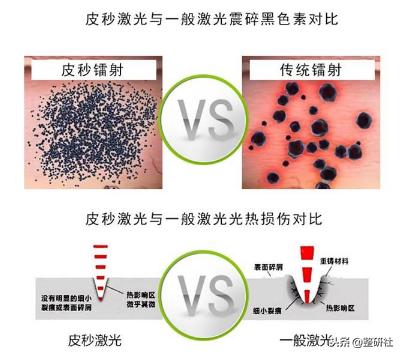 选择光电祛斑，出门再也不担心颜值掉线