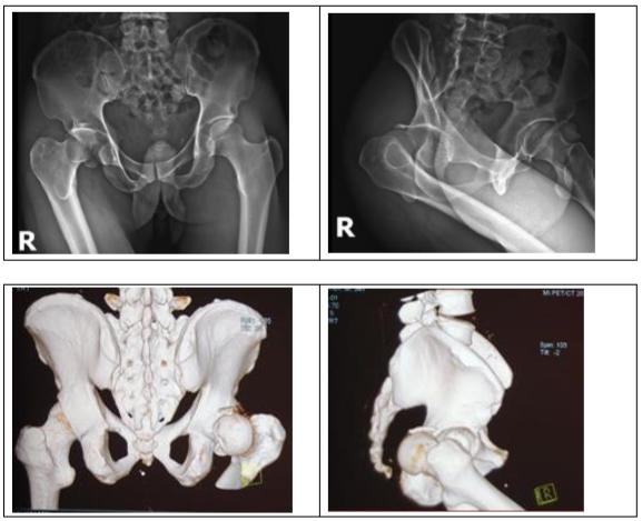 pipkin骨折,pipkin的视频