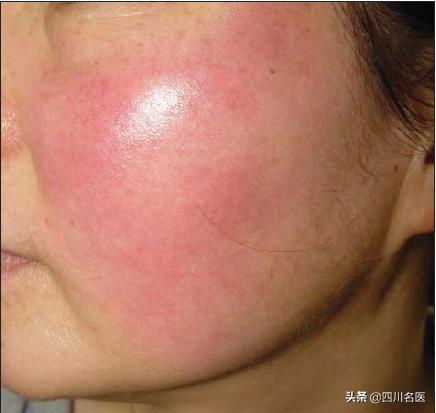 一把年纪了脸上还爆痘,一把年纪了脸上还起痘