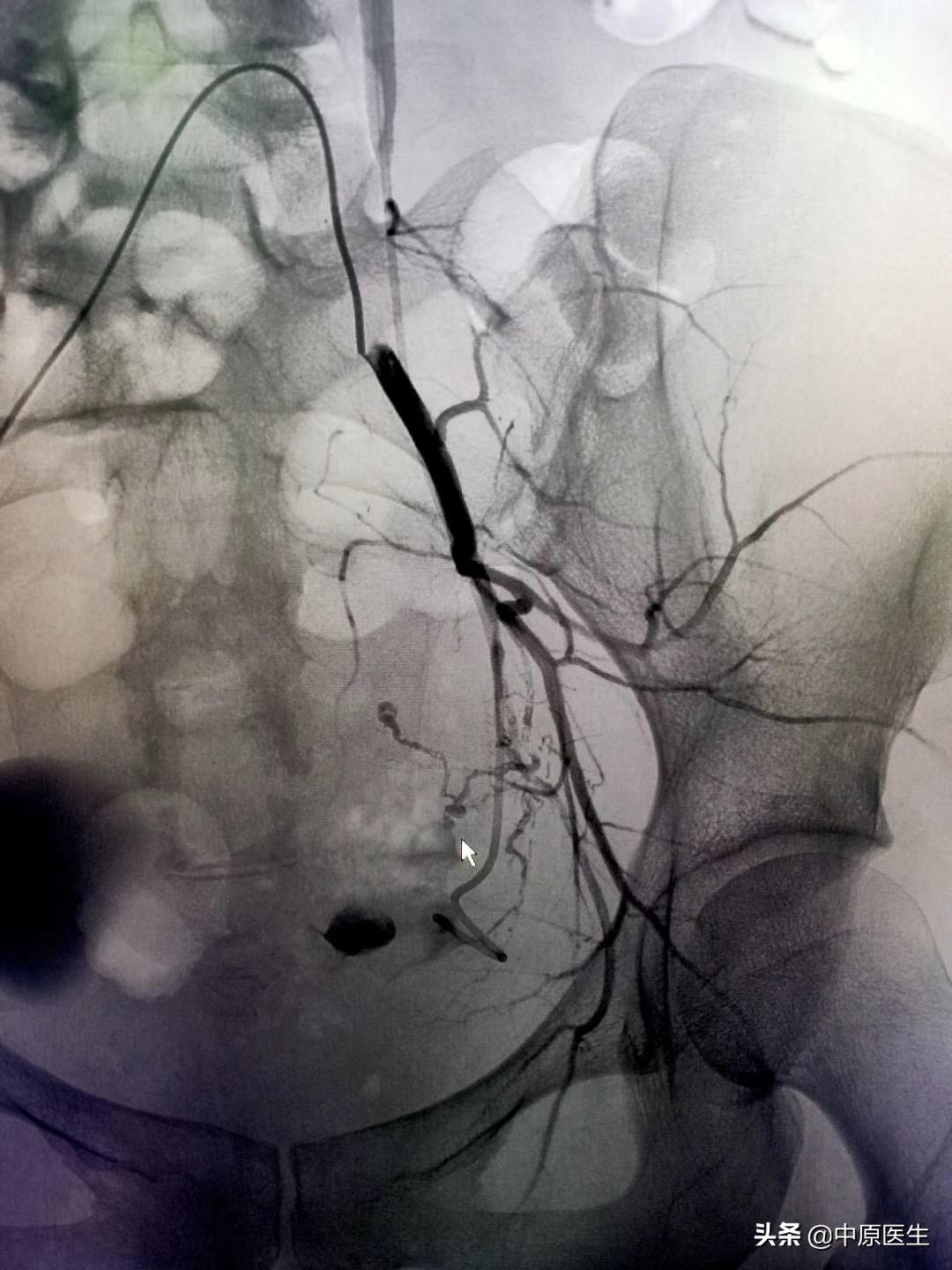 鎴戝湪鏂板啝鐤儏涓殑缁忓巻,鍦ㄦ柊鍐犵柅鎯呮劅鏌撲笅鐨勬垜