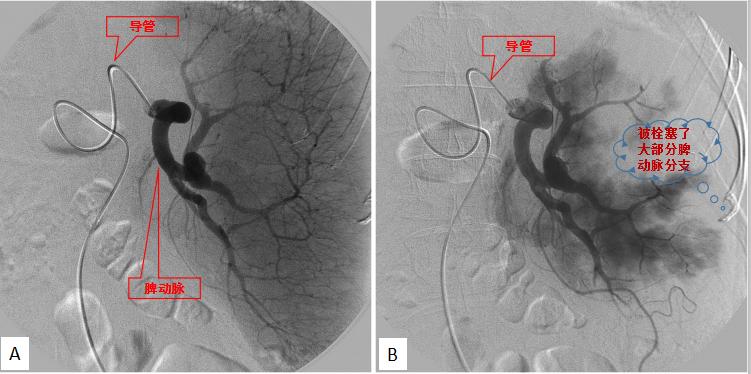 血管栓塞术治疗肿瘤,血管介入栓塞治肿瘤