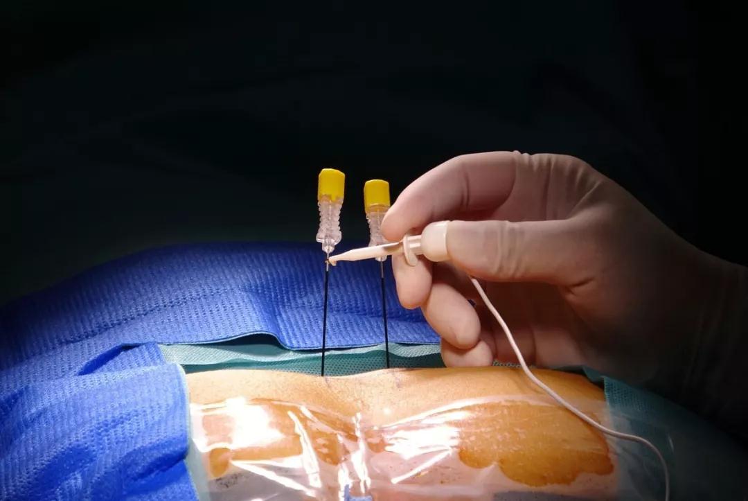 骶神经刺激器植入术效果,全面开展神经调控技术