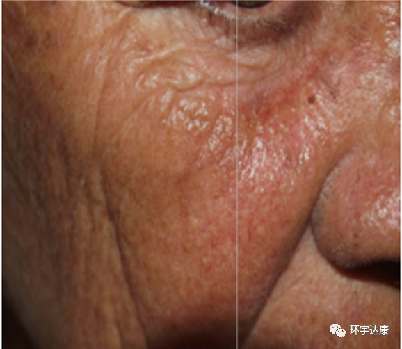 古巴癌症疫苗效果怎么样,古巴已经发明了抗肺癌的疫苗吗