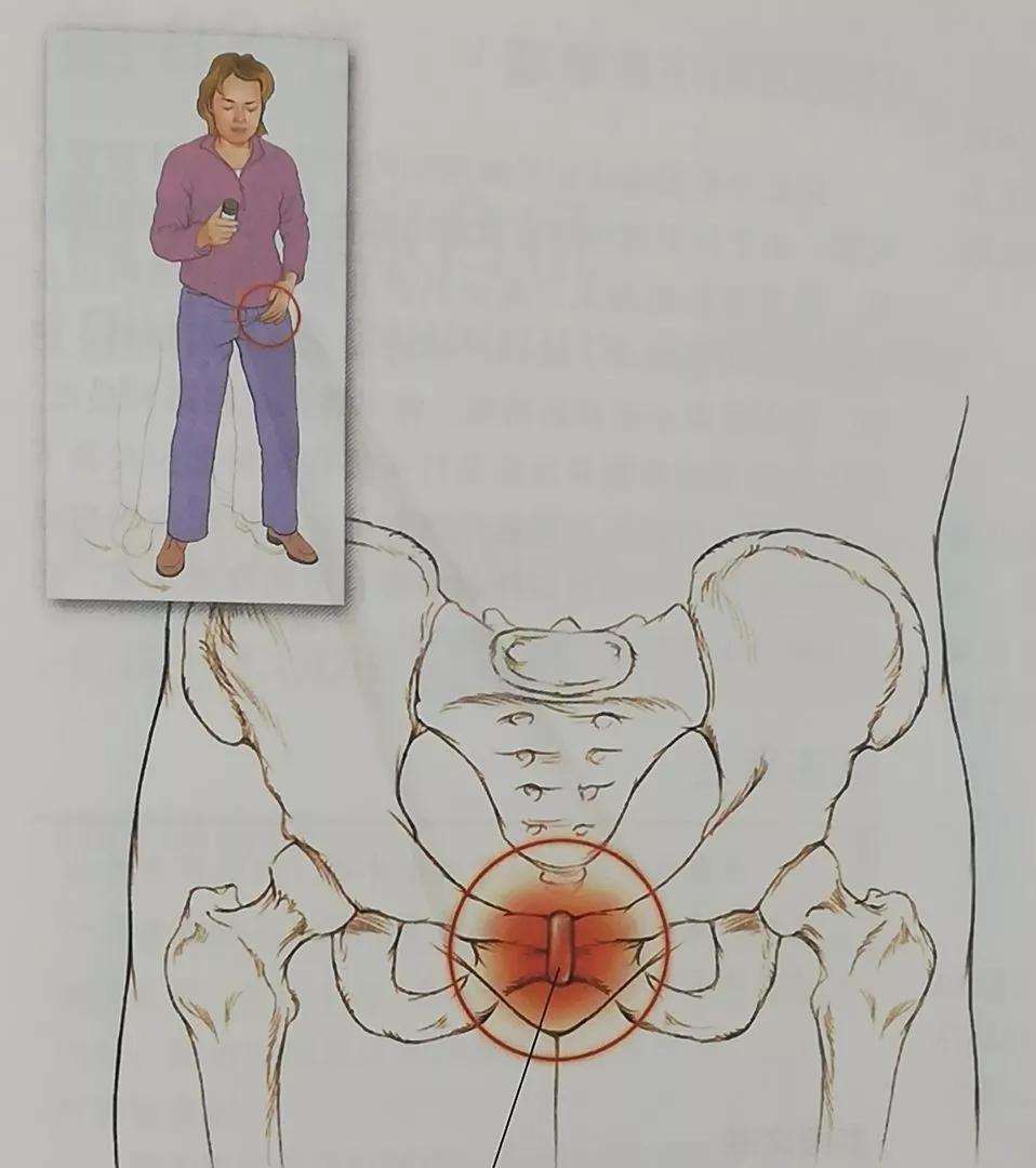 收藏综合征,男性骨盆疼痛综合征