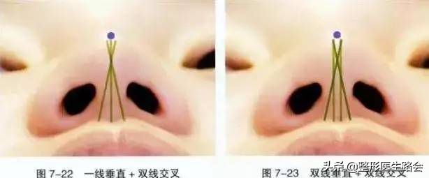 为什么不建议做线雕手术,为什么不推荐做线雕鼻