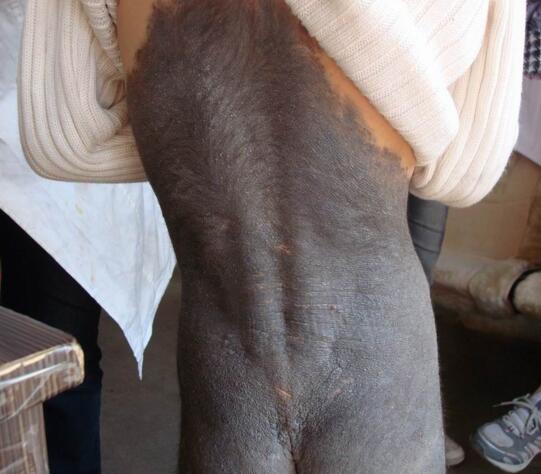 大面积兽皮痣最好的治疗方法,先天性兽皮痣能治好吗