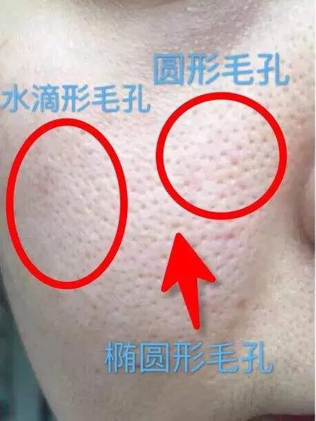 毛孔粗大可以永久缩小吗,毛孔粗大能缩小吗告诉你真相