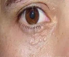 长了汗管瘤容易长皱纹,为什么会长汗管瘤和脂肪粒