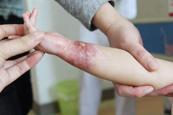孩子被烫伤紧急急救,小儿意外烫伤要如何急救