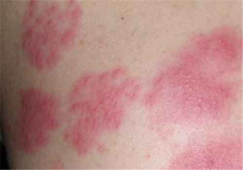 治疗带状疱疹用哪几种药配合最好,带状疱疹治疗方法及用药注意事项