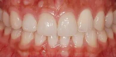 牙缝越来越大是什么导致的,牙缝越来越大什么病中医怎么说