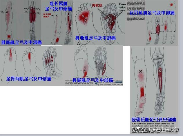 激痛点挂图,激痛点疗法笔记