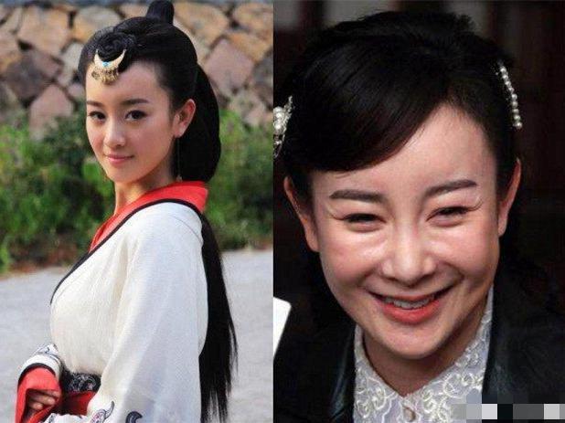 为什么打了玻尿酸脸更大了,女明星打了玻尿酸笑僵脸