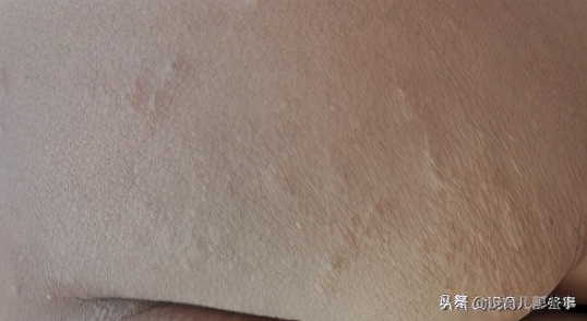 最奇葩的过敏图片,各种各样的过敏图片