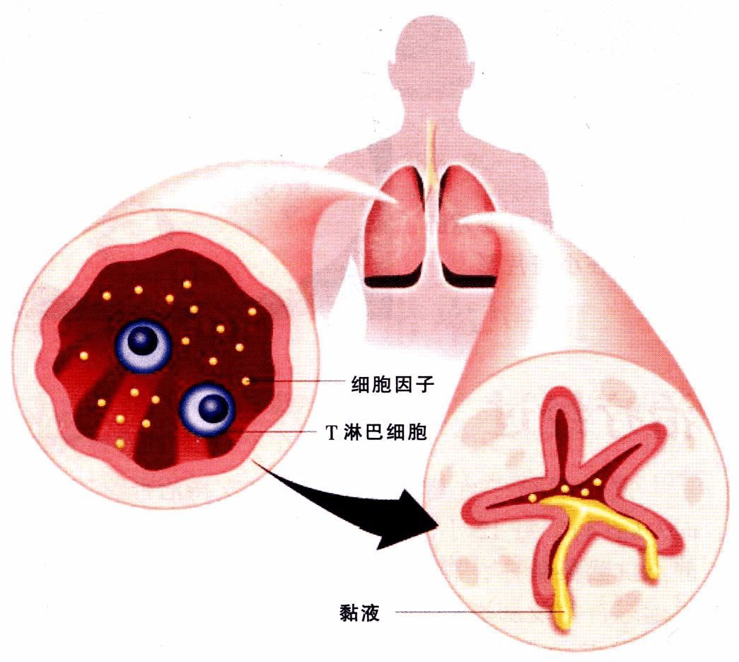 得了哮喘应该怎么开导自己,有哮喘要怎么办比较好