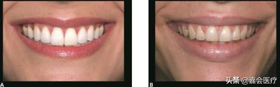 怎么不露齿笑才自然好看,如何笑不露齿笑起来好看的技巧