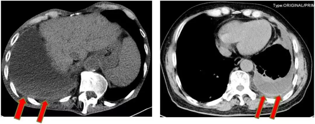 胸部超声引导下穿刺活检术流程,ct引导下肺穿刺活检优缺点