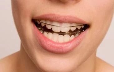 牙齿矫正后保持器佩戴多长时间,牙齿矫正后佩戴保持器注意事项