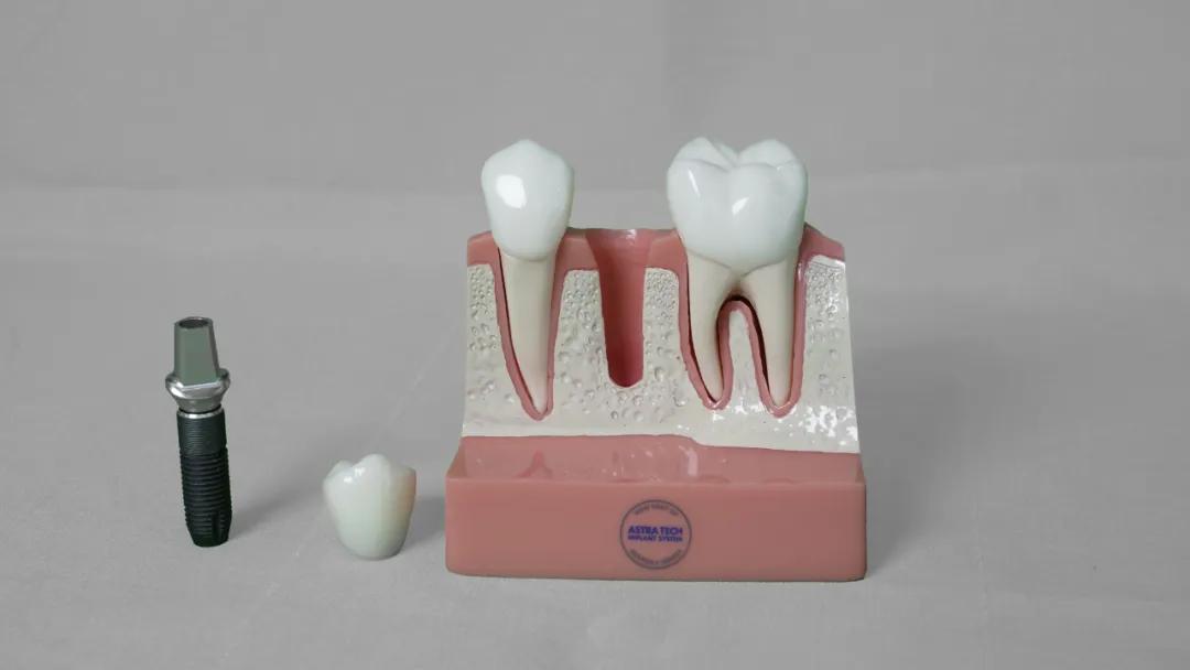 种牙真实过程,种牙是拧螺丝吗