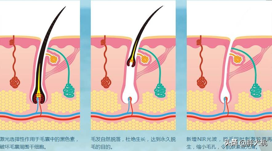 女性猕猴桃脱毛方法,怎样脱毛能让毛越脱越少
