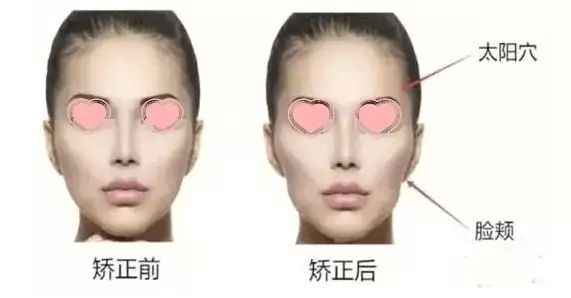 整牙会有牙缝吗,整牙会出现牙齿松动吗