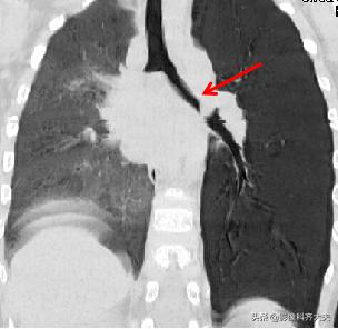 ct能查出气管微小异物嘛,气管异物ct怎么做