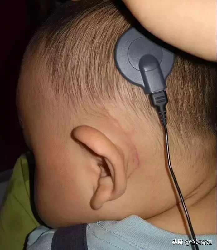 听障儿童耳蜗没反应怎么办,听障儿童听力缺失还能植入耳蜗吗