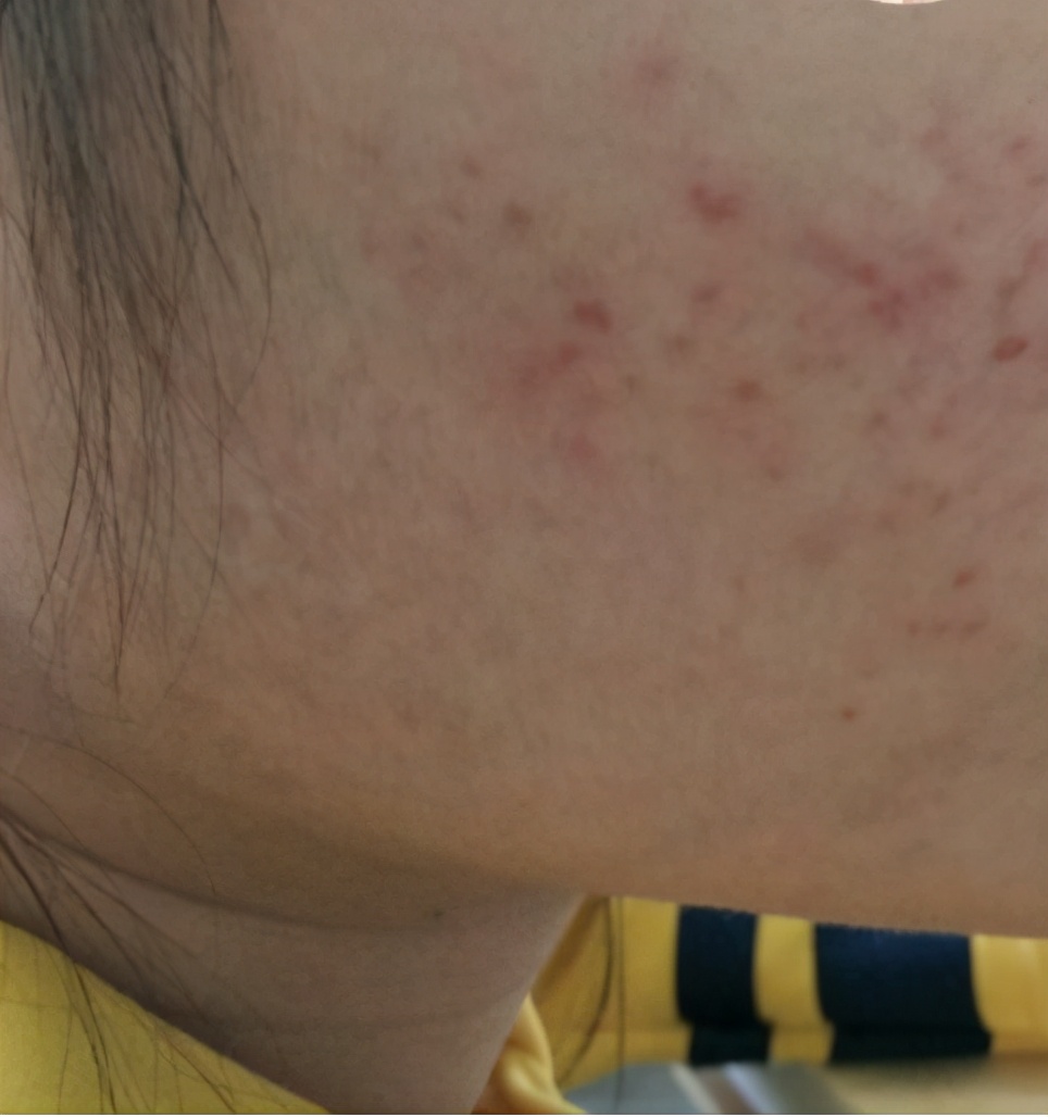 有哪些祛痘痘和祛痘印的产品,怎样祛痘痘和痘印最快最有效的