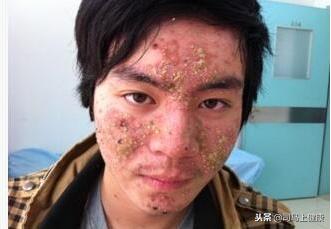 还在为宝宝湿疹烦恼吗,湿疹不可怕按一个穴位就可以解决