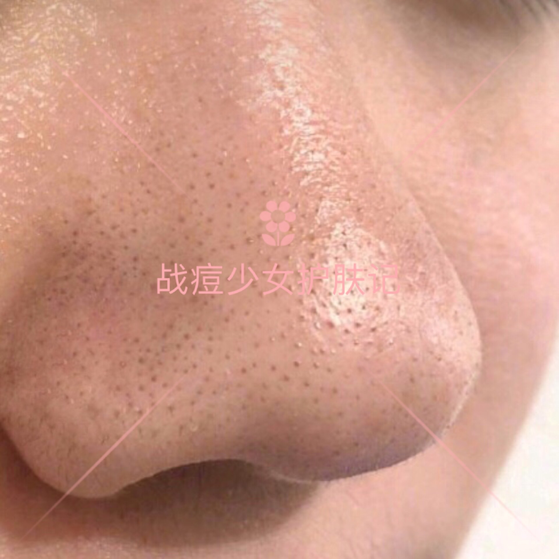 6种痘痘对号入座，1分钟教会你认清痘痘类型，对症战痘！