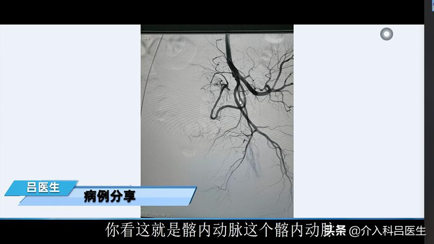 子宫肌瘤不想做腹腔镜怎么办,子宫肌瘤切除微创手术