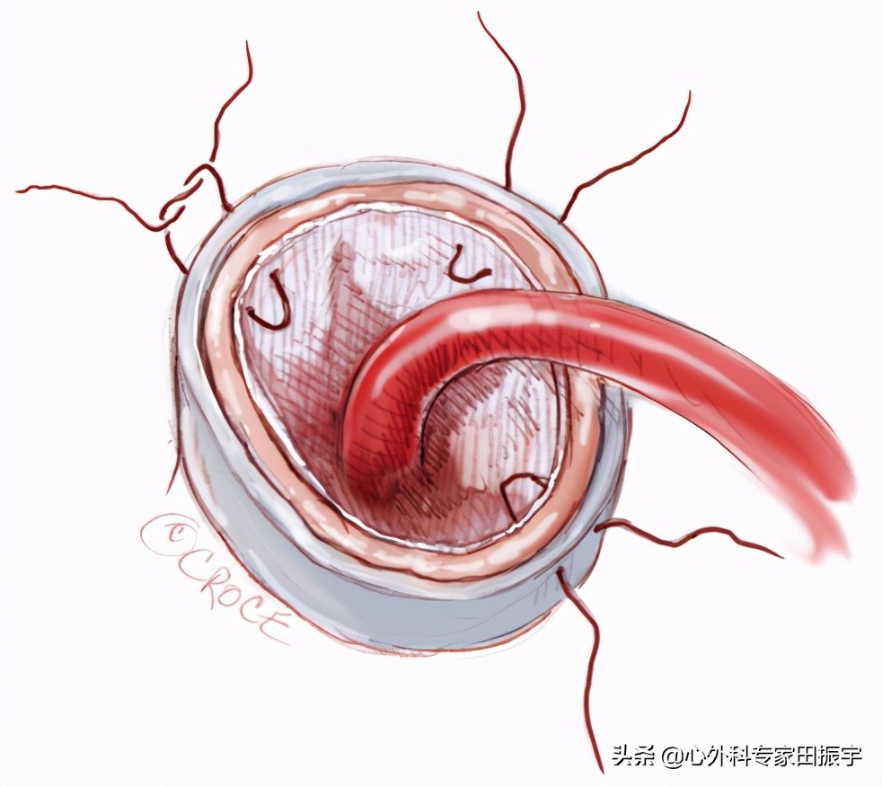 主动脉夹层破裂b型,急性主动脉夹层动脉瘤破裂