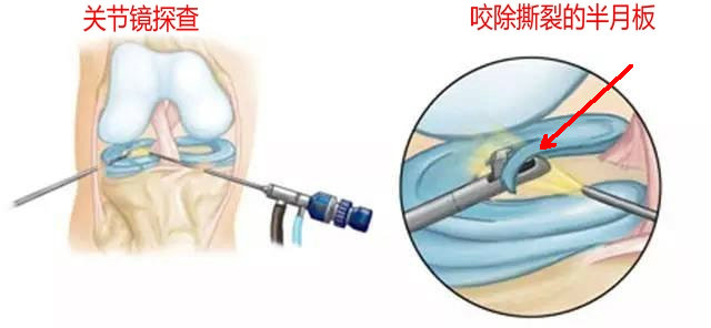 磁共振图片讲解半月板损伤的程度,磁共振半月板损伤严重