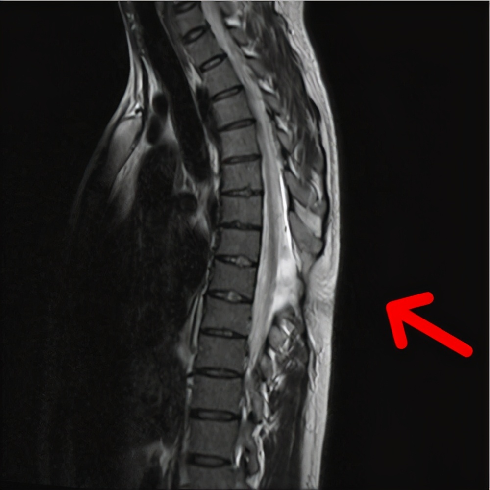 高弓足的保守锻炼治疗方法是什么,高弓足的表现和危害