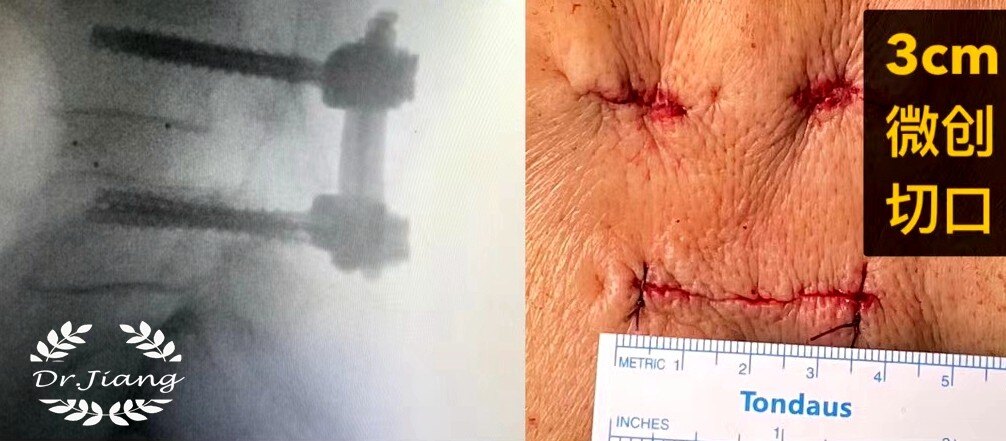 腰椎退行性变诊断书怎么写,腰椎退行性滑脱最好的治疗方法