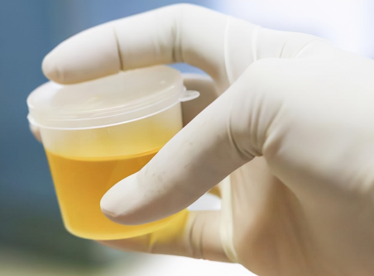 上厕所尿黄什么原因有异味,上厕所尿液黄色还有一点痛