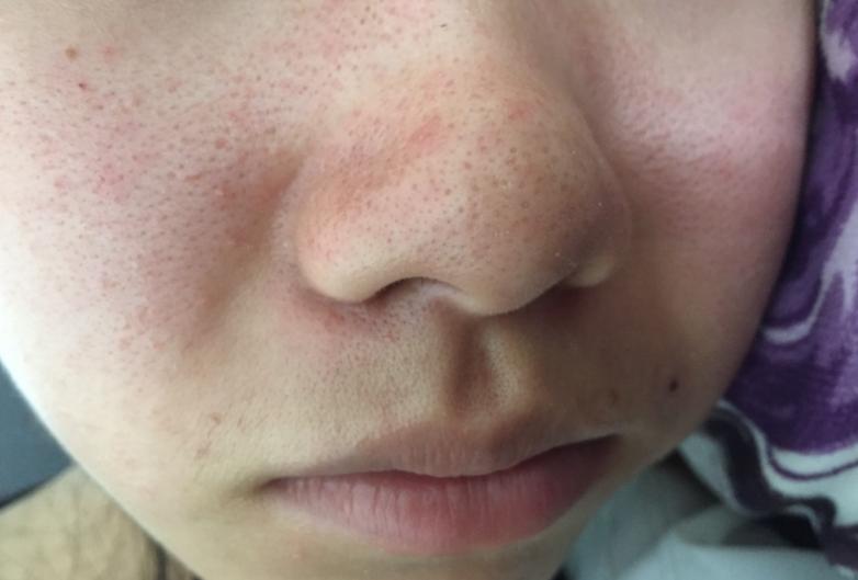 吃盐太多对肾有损坏吗,为什么吃盐多引起血压升高