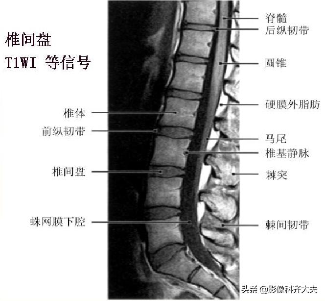 腰椎间盘突出最好的影像诊断方法,腰椎间盘突出的影像学检查