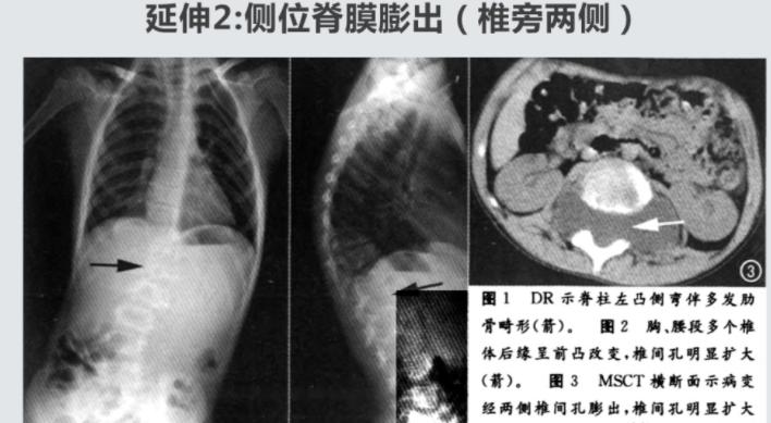 胎儿神经管闭合不全是什么原因,隐性神经管闭合不全