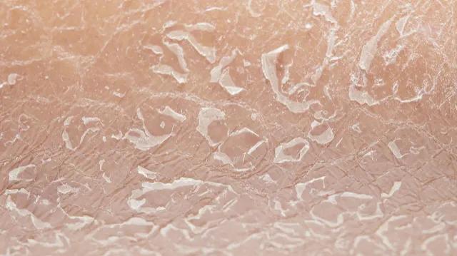 冬天裤子上很多白色皮屑怎么去除,冬天腿上干燥起白皮屑