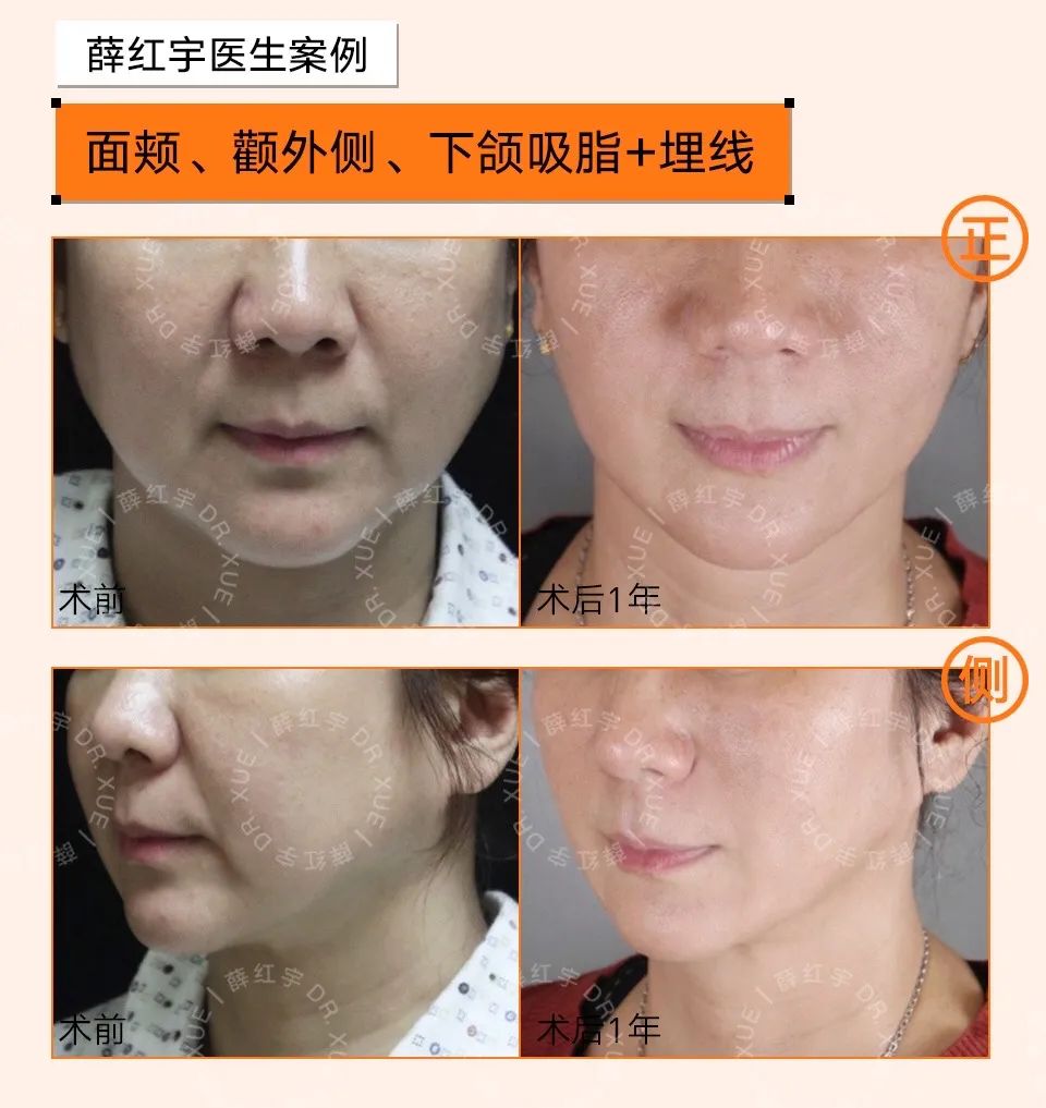 脾胃好了法令纹会改善吗,面部瑜伽能改善法令纹吗