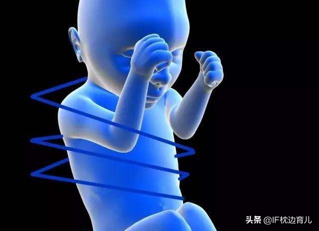 胎儿脐带绕颈有办法吗,胎儿脐带绕颈