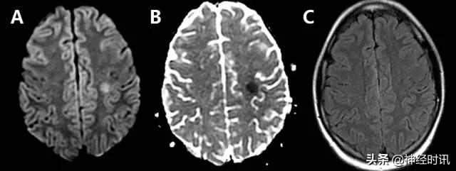 脑卒中的快速识别ppt,脑卒中神经影像学实例解析