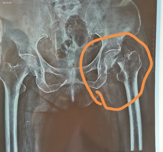 老人摔伤股骨头骨折咋办,老年人摔倒致股骨颈骨折如何处理