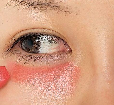 血管型黑眼圈怎么消除,戴眼镜黑眼圈怎么消除